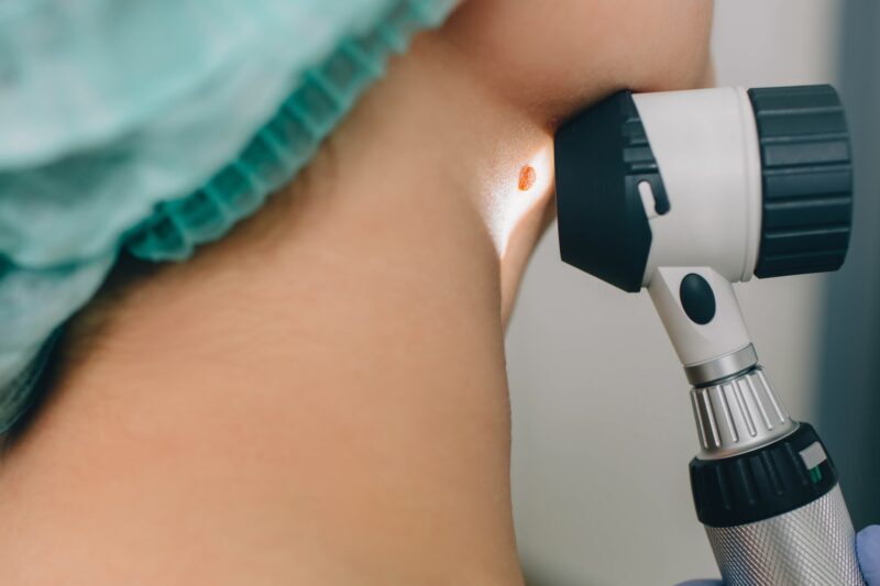 skin moles treatment. Laser Mole Removal at clinic