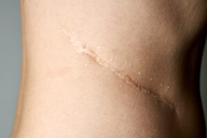 Visable Scarring on the side of a womans body