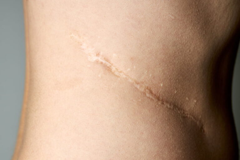 Visable Scarring on the side of a womans body