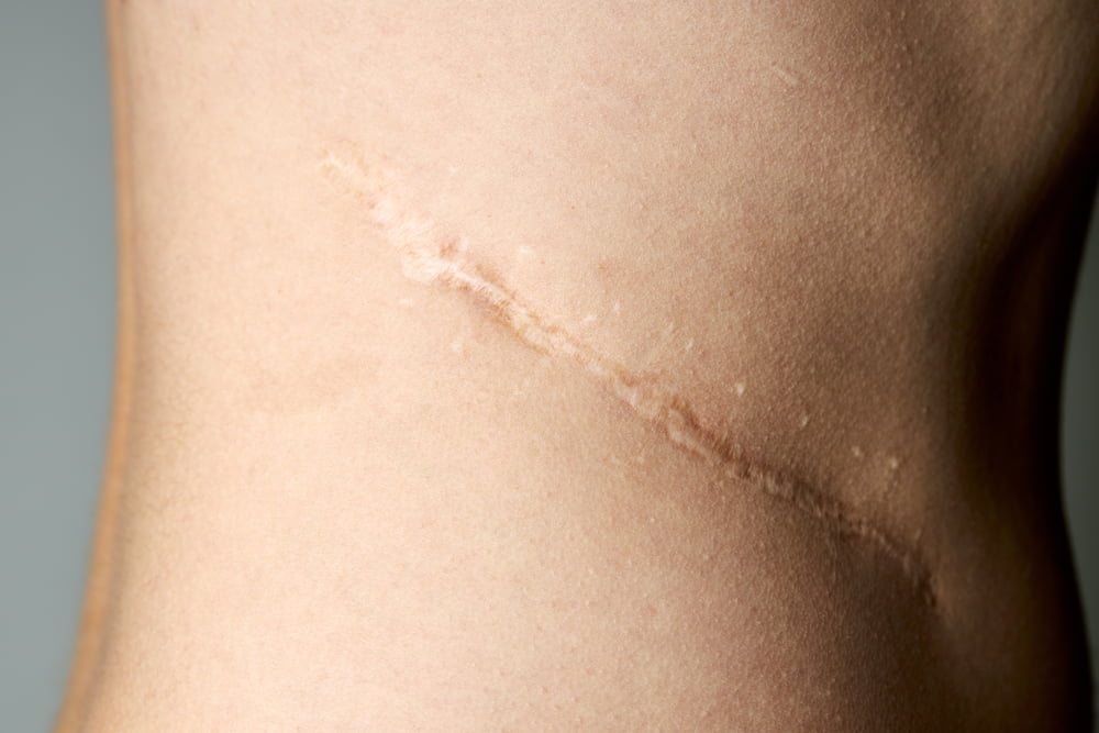 Visable Scarring on the side of a womans body